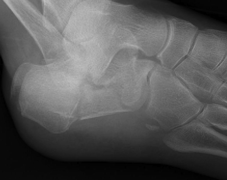 Calcaneal Fracture Oblique Xray